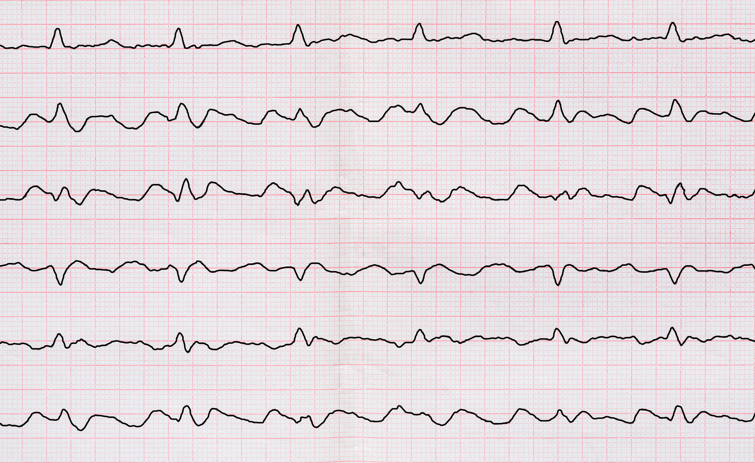 NICE wants more data before recommending heart arrhythmias device