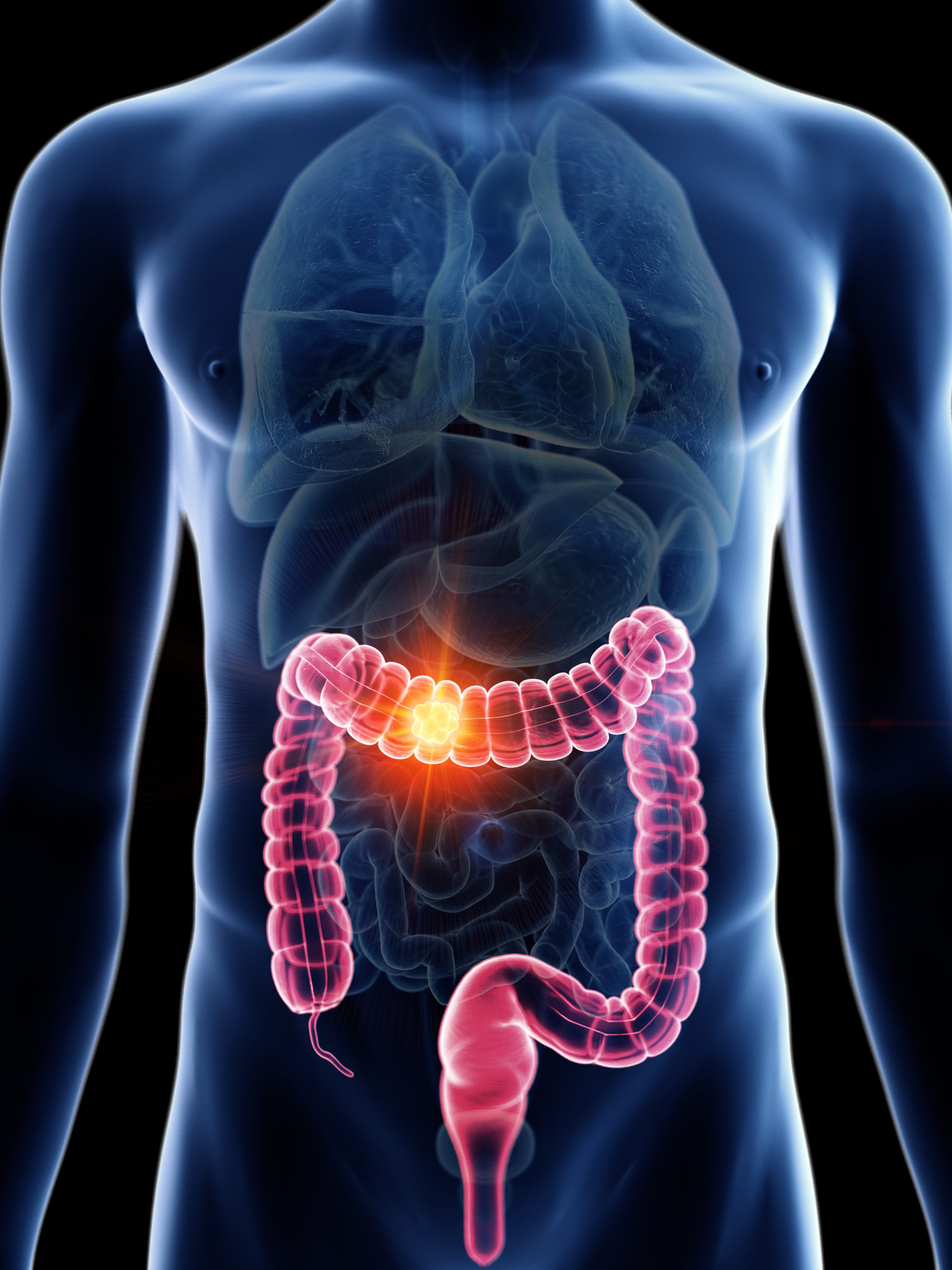Colon capsule cameras enable COVID-secure cancer checks