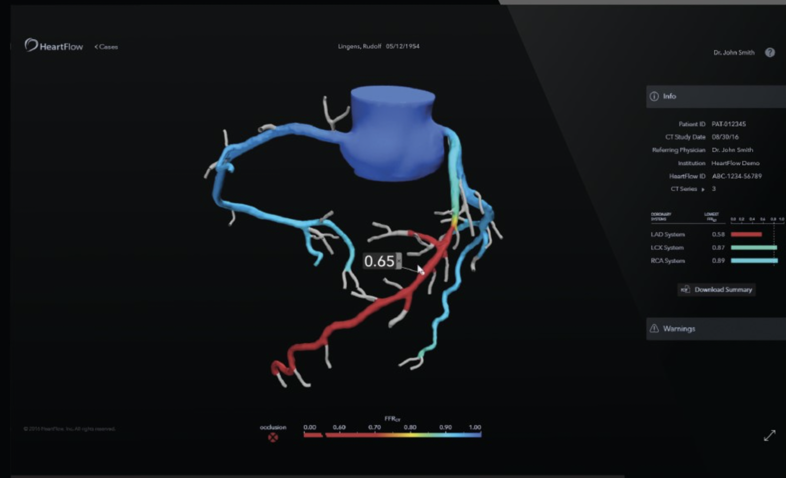How 3D models are transforming heart care